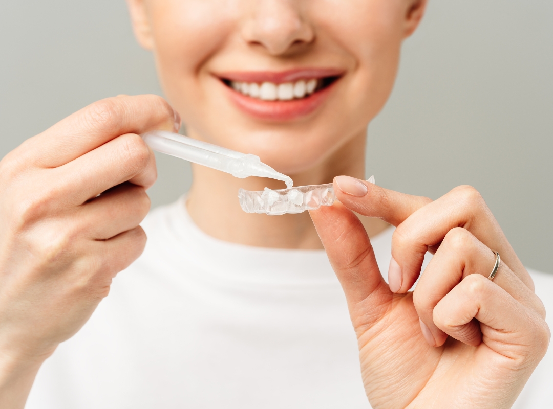 Clareamento Dental Funciona Mesmo ou É Só Ilusão? A Verdade Que Poucos Contam